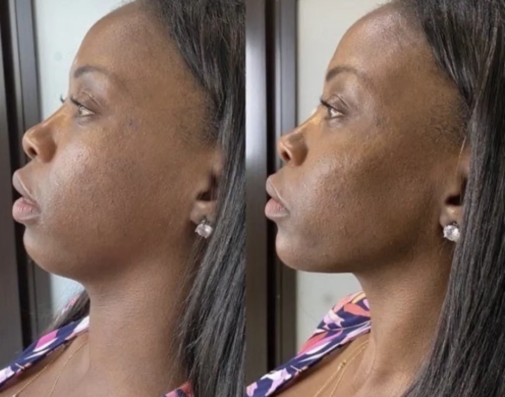 Jawline Filler before and after reawakenmedspa a