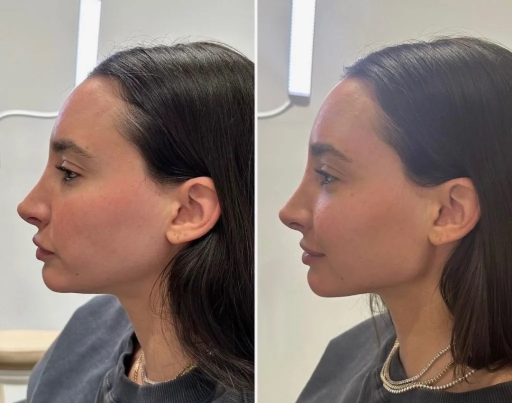 Jawline Filler before and after reawakenmedspa b